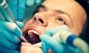 Want to maintain Dental Filing for a Long Time? 1 Want to maintain Dental Filing for a Long Time?